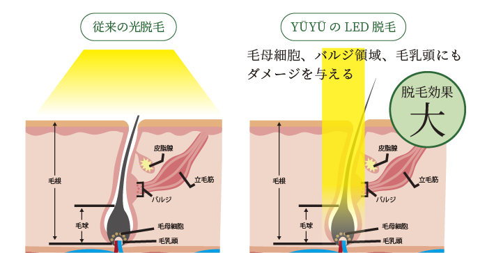 ED脱毛と従来の脱毛の違い説明画像